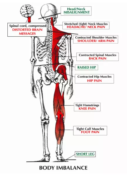 The Link Between Posture and Chronic Neck and Upper Back Pain — Back Pain  and Headache Specialist - Burke VA - NOVA Headache & Chiropractic Center